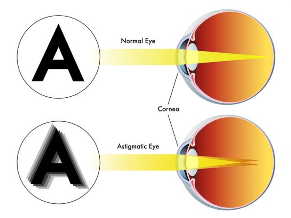 Lehet-e normál látású szemüveget viselni?, Mit jelent a cilinderes szem?